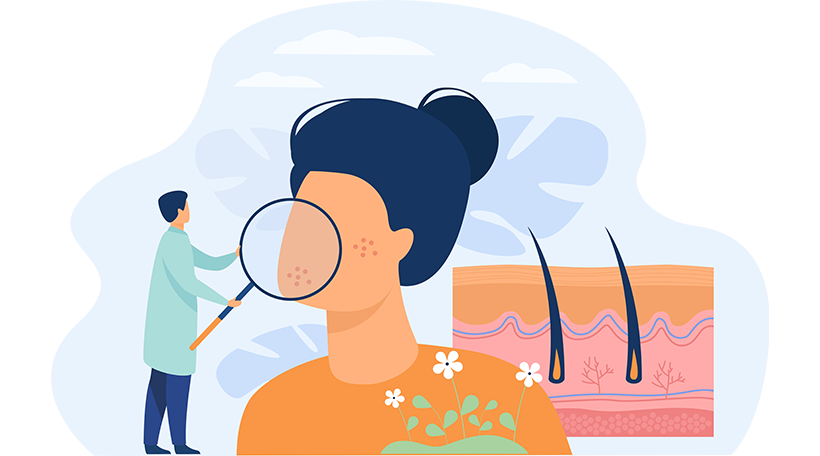 лікування запалення шкіри акне